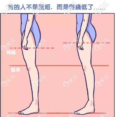 大腿吸脂后臀部下垂可以提升臀线来修复和改善