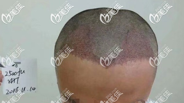 额角植发2500毛囊单位术后即刻