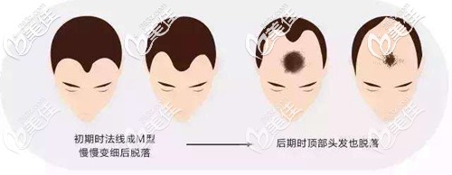 脱发是逐渐形成的,要引起重视 脱发是逐渐形成的,要引起重视