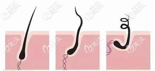 毛囊萎缩、脱发的演变过程 毛囊萎缩、脱发的演变过程