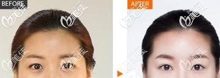 吴金峰双眼皮案例效果