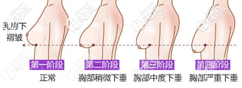 乳房下垂程度示意图