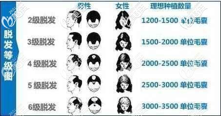 不同等级脱发所需的毛囊个数 不同等级脱发所需的毛囊个数