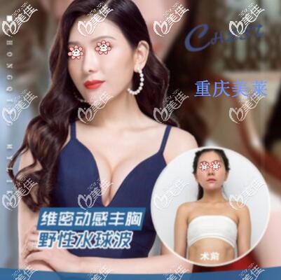 重庆美莱假体隆胸效果 重庆美莱假体隆胸效果