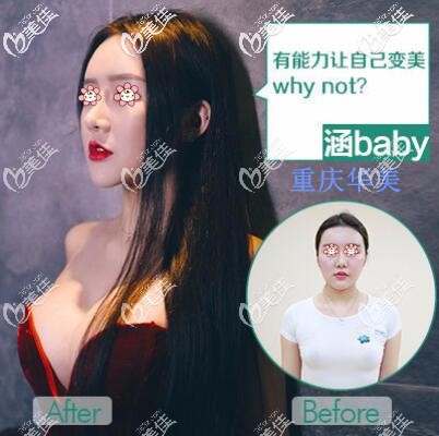 重庆华美陈德法隆胸案例 重庆华美陈德法隆胸案例