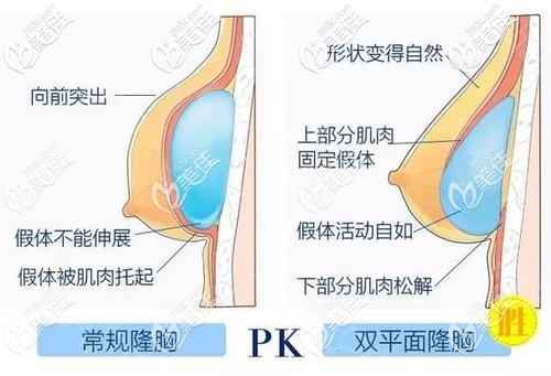姜昌军医生采用内窥镜双平面隆胸术