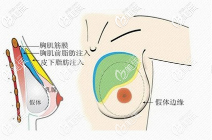 丽人整形姜昌军医生做复合隆胸手术