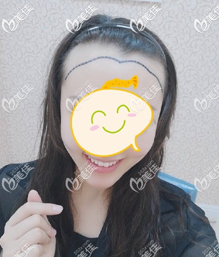 在植发前,医生给我进行术前设计 在植发前,医生给我进行术前设计