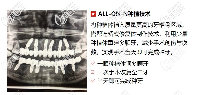 全口牙齿的种植技术