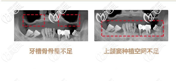 骨增量种植