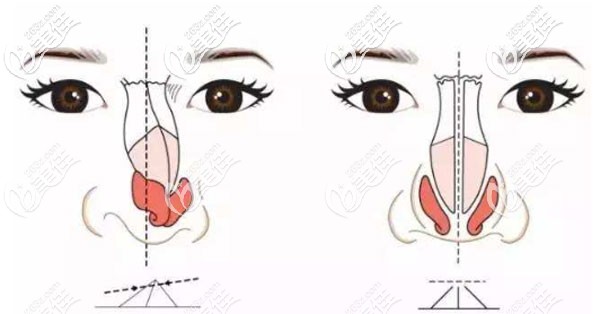 整形胡凯做鼻子多少钱 整形胡凯做鼻子多少钱