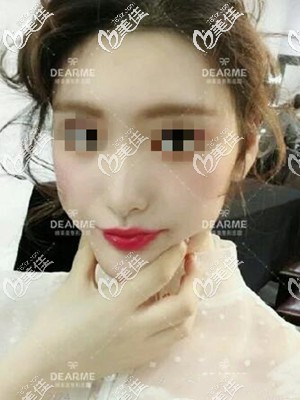 不知道颧骨高是磨骨还是脂肪填充好的戳进来看案例对比照选择适合你的