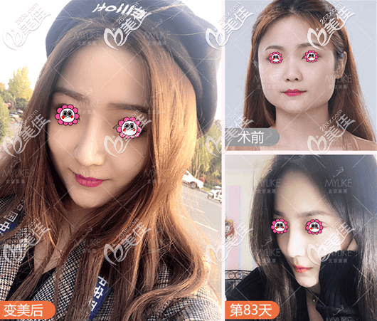 北京美莱<!--<i data=20240703-sp></i>-->医生耳软骨复合隆鼻 北京美莱<!--<i data=20240703-sp></i>-->医生耳软骨复合隆鼻