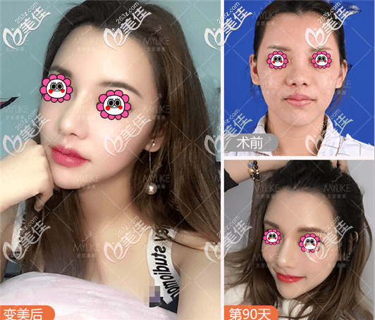 北京美莱<!--<i data=20240703-sp></i>-->医生假体鼻综合隆鼻 北京美莱<!--<i data=20240703-sp></i>-->医生假体鼻综合隆鼻