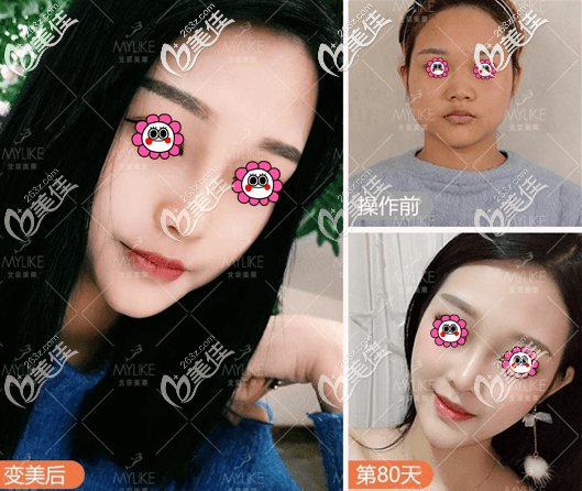 北京美莱叶医生Dallas综合隆鼻 北京美莱叶医生Dallas综合隆鼻