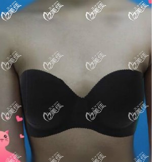 伊思雅假体隆胸术前