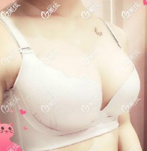 伊思雅假体隆胸术后效果