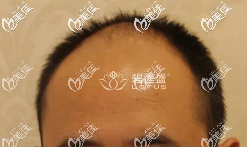 植发前,脱发面积较大 植发前,脱发面积较大