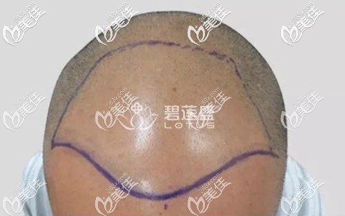 经过术前设计,需要植发的区域不小 经过术前设计,需要植发的区域不小