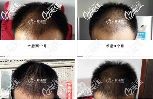 头顶植发1到8个月效果图 头顶植发1到8个月效果图