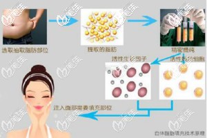 脸部自体脂肪填充技术原理图解 脸部自体脂肪填充技术原理图解