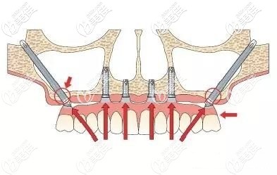 穿颧穿翼板种植牙 穿颧穿翼板种植牙