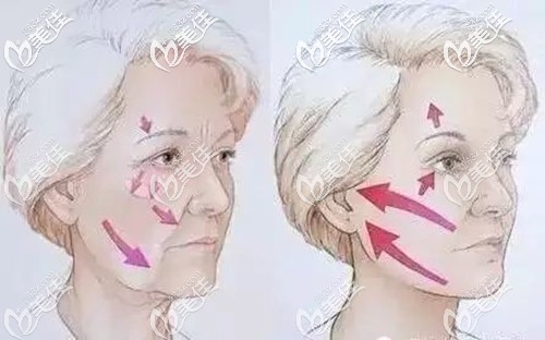 面部埋线提升可以改善皮肤松弛下垂