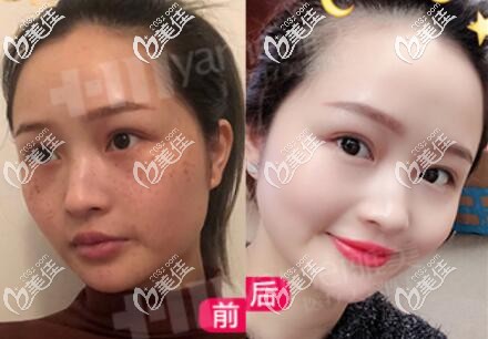 做皮秒激光祛斑术前术后对比照 做皮秒激光祛斑术前术后对比照