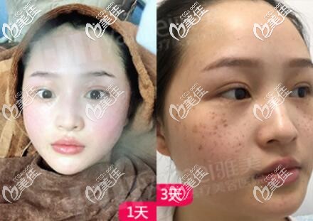 在雅美做皮秒激光祛斑术后效果照 在雅美做皮秒激光祛斑术后效果照