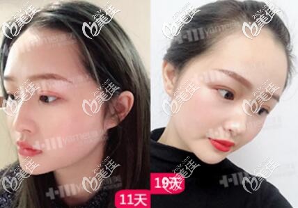 皮秒激光祛斑术后半个月左右效果照 皮秒激光祛斑术后半个月左右效果照