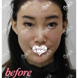 激光祛斑前黄褐斑较多 激光祛斑前黄褐斑较多