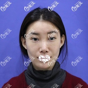 做超皮秒祛黄褐斑术后一周结痂 做超皮秒祛黄褐斑术后一周结痂