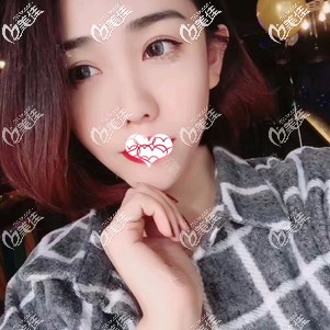 超皮秒祛斑术后15天面部皮肤变白净 超皮秒祛斑术后15天面部皮肤变白净