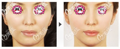 广比利次医生颧骨整形案例