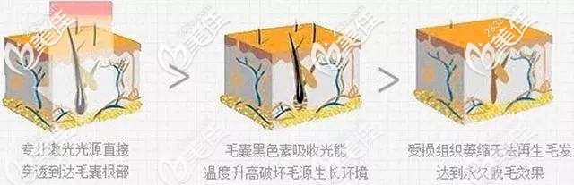 激光脱毛的手术原理