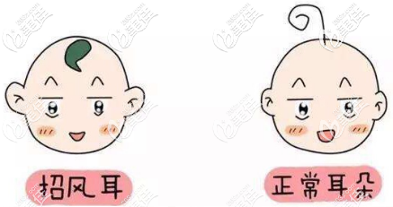 泰国圣卡洛整形医院招风耳矫正需要多钱？