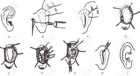 泰国圣卡洛整形医院招风耳矫正效果怎么样？