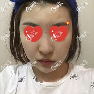 术前的我大鼻头 术前的我大鼻头