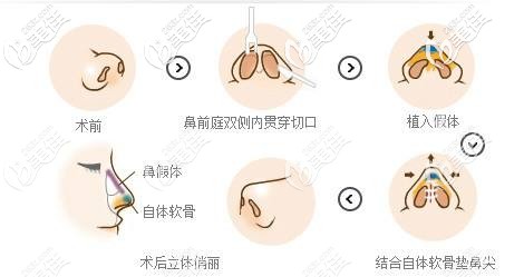 鼻综合手术原理图 鼻综合手术原理图