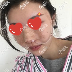 做完鼻综合手术后即刻有变化 做完鼻综合手术后即刻有变化