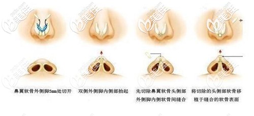 咸福实医生做鼻综合手术过程