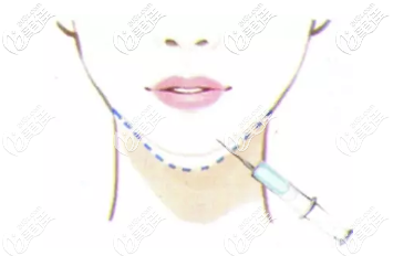 自体脂肪填充下巴手术原理