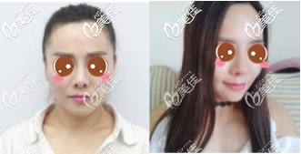 重庆华美下颌角整形真人案例 重庆华美下颌角整形真人案例