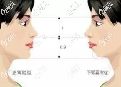 正常下巴与后缩的下巴的对比照 正常下巴与后缩的下巴的对比照