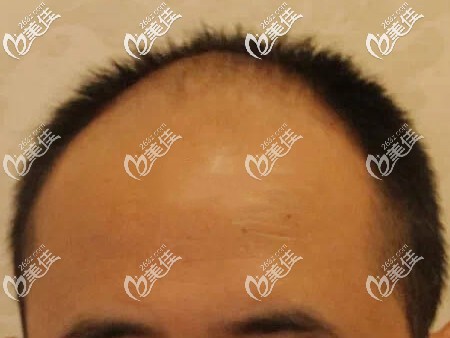 头顶A型脱发示例图 头顶A型脱发示例图