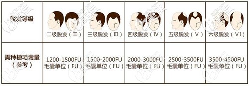 不同脱发等级毛囊种植图 不同脱发等级毛囊种植图