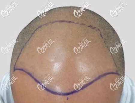 头顶加密植发3000单位设计图 头顶加密植发3000单位设计图