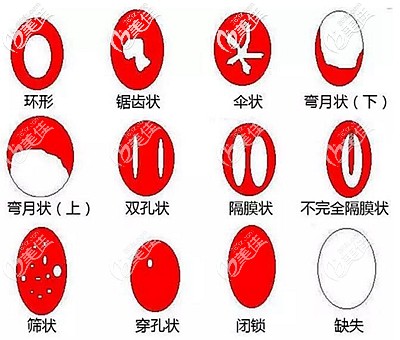 处女膜的所有形态 处女膜的所有形态