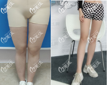 任学会医生做大腿吸脂的手术案例 任学会医生做大腿吸脂的手术案例