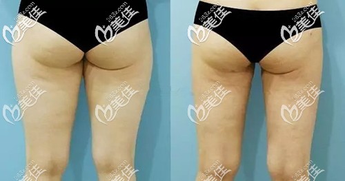 臀部吸脂前后对比案例 臀部吸脂前后对比案例